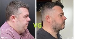 Before and after double chin liposuction at VG Plastic Surgery, visible jawline contour result