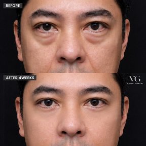 Before and after lower blepharoplasty at VG Plastic Surgery, reduced under-eye bags result