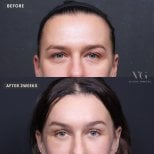 Facial feminization surgery before and after results at VG Plastic Surgery, 2 weeks post-op