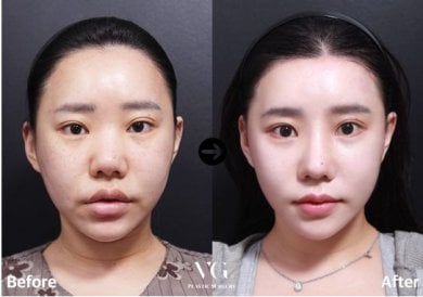 Facial feminization surgery before and after results at VG Plastic Surgery, softer facial features