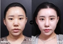 Facial feminization surgery before and after results at VG Plastic Surgery, softer facial features