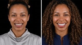 Vorher-nachher-Ergebnis Veneers – strahlendes Lächeln mit gleichmäßigen Zähnen