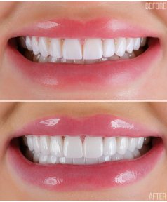 Vorher-nachher-Veneers Ergebnis – weißeres, ebenmäßiges Lächeln in der Zahnklinik