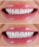 Vorher-nachher-Veneers Ergebnis – weißeres, ebenmäßiges Lächeln in der Zahnklinik