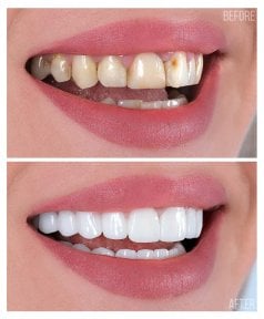 Vorher-nachher Veneers Ergebnis – Lächeln mit weißen, gleichmäßigen Zähnen