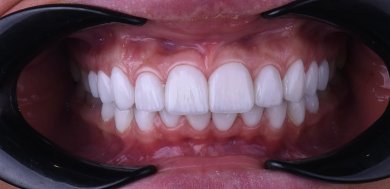 Результат дентального імпланта в Dentaland Premium Luxury Clinic & Academy – природна усмішка