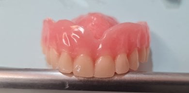 Resultado de prótesis sobre implantes en SoftDentalCare Clinic, restauración dental superior