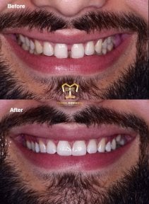 Результати до і після зубної імплантації в Dentaland Premium Luxury Clinic & Academy, посмішка відновлена