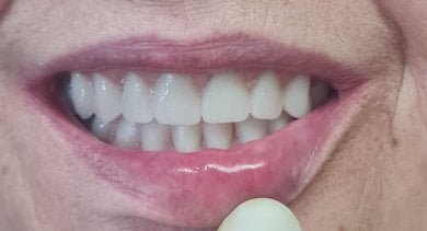 Resultado de implante dental en SoftDentalCare Clinic: sonrisa natural restaurada tras el procedimiento