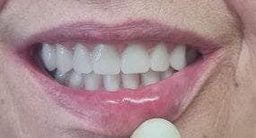 Resultado de implante dental en SoftDentalCare Clinic: sonrisa natural restaurada tras el procedimiento
