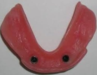 Resultado de prótesis dental sobre implantes en SoftDentalCare Clinic para mayor estabilidad