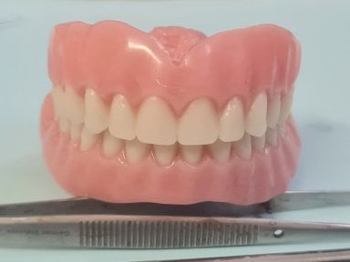 Resultado de implante dental en SoftDentalCare Clinic: dentadura artificial de aspecto natural