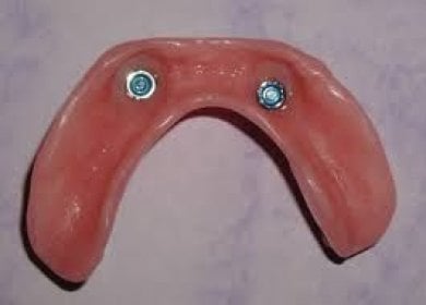 Resultado de prótesis sobre implantes dentales en SoftDentalCare Clinic, ajuste seguro y natural