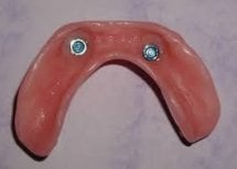 Resultado de prótesis sobre implantes dentales en SoftDentalCare Clinic, ajuste seguro y natural