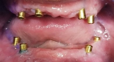 Resultado de colocación de implantes dentales en SoftDentalCare Clinic, con pilares visibles