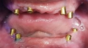 Resultado de colocación de implantes dentales en SoftDentalCare Clinic, con pilares visibles