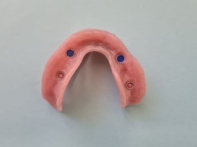 Prótesis de implante dental para restauración maxilar en SoftDentalCare Clinic, resultado visible