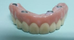 Prótesis All-on-4 en SoftDentalCare Clinic, resultado de restauración dental fija