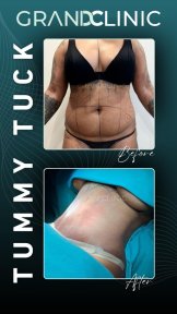 Before and after tummy tuck results at Grand Clinic – visible abdominal contour improvement