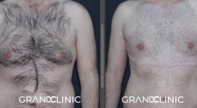 До и после установки грудных имплантов в Grand Clinic, улучшенный контур груди