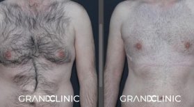 До и после установки грудных имплантов в Grand Clinic, улучшенный контур груди