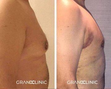 До и после установки грудных имплантов в Grand Clinic, улучшенный контур груди