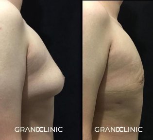 До и после установки грудных имплантов в Grand Clinic, улучшенный контур груди