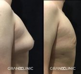 До и после установки грудных имплантов в Grand Clinic, улучшенный контур груди