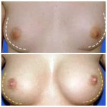 Before and after breast implant revision at Klinika La Perla, improved breast shape result