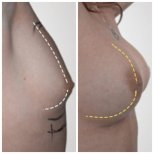 Before and after breast implant revision at Klinika La Perla, improved breast contour result