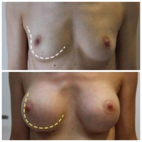 Before and after breast implant revision at Klinika La Perla, improved breast symmetry result