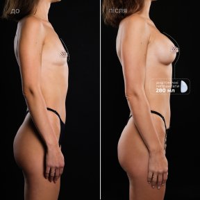 before-after photo mammoplasty