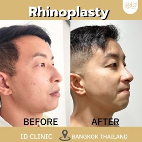 before-after photo revision-rhinoplasty