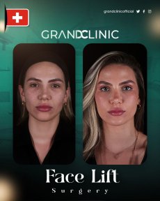 before-after photo feminizacia-lica