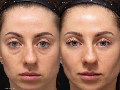 before-after photo lower-eyelid-surgery