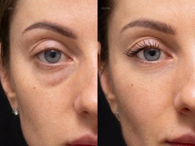 before-after photo lower-eyelid-surgery