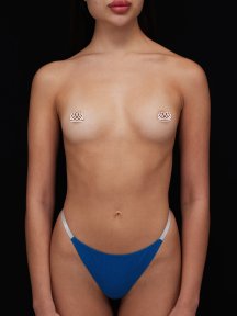 before-after photo breast-augmentation