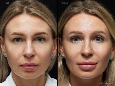 before-after photo blepharoplasty-eyelid
