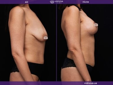 before-after photo mastopexy-breast-lift-contour-plastics