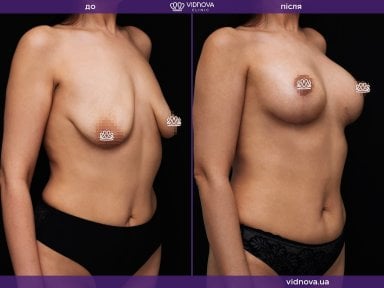 before-after photo mastopexy-breast-lift-contour-plastics