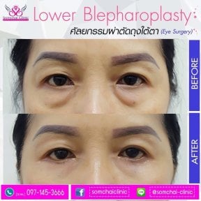 Lower blepharoplasty before and after results at Somchai Clinic, reduced under-eye bags