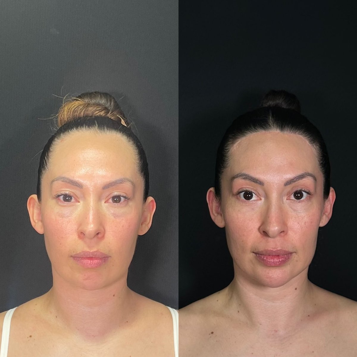 Resultados de antes y después de contorno de frente en Zafir Medical Center, perfil facial mejorado