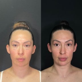 Before and after forehead contouring results at Zafir Medical Center, facial profile enhancement