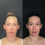 Before and after forehead contouring results at Zafir Medical Center, facial profile enhancement