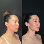 Resultados antes y después de contorno de frente en Zafir Medical Center, perfil facial mejorado