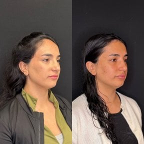 Résultats avant/après du remodelage du front au Zafir Medical Center, profil du visage amélioré