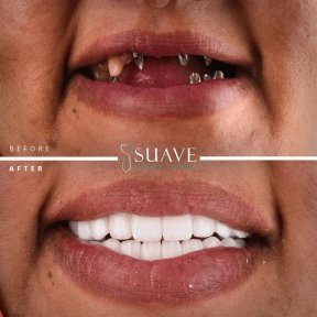 before-after photo denture