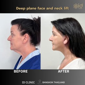 Résultats avant/après lifting visage et cou profond à ID Clinic Bangkok