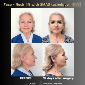 Résultats avant/après lifting visage et cou SMAS à ID Clinic Bangkok, effet visible
