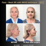 Résultats avant/après lifting visage et cou SMAS à ID Clinic Bangkok, effet visible